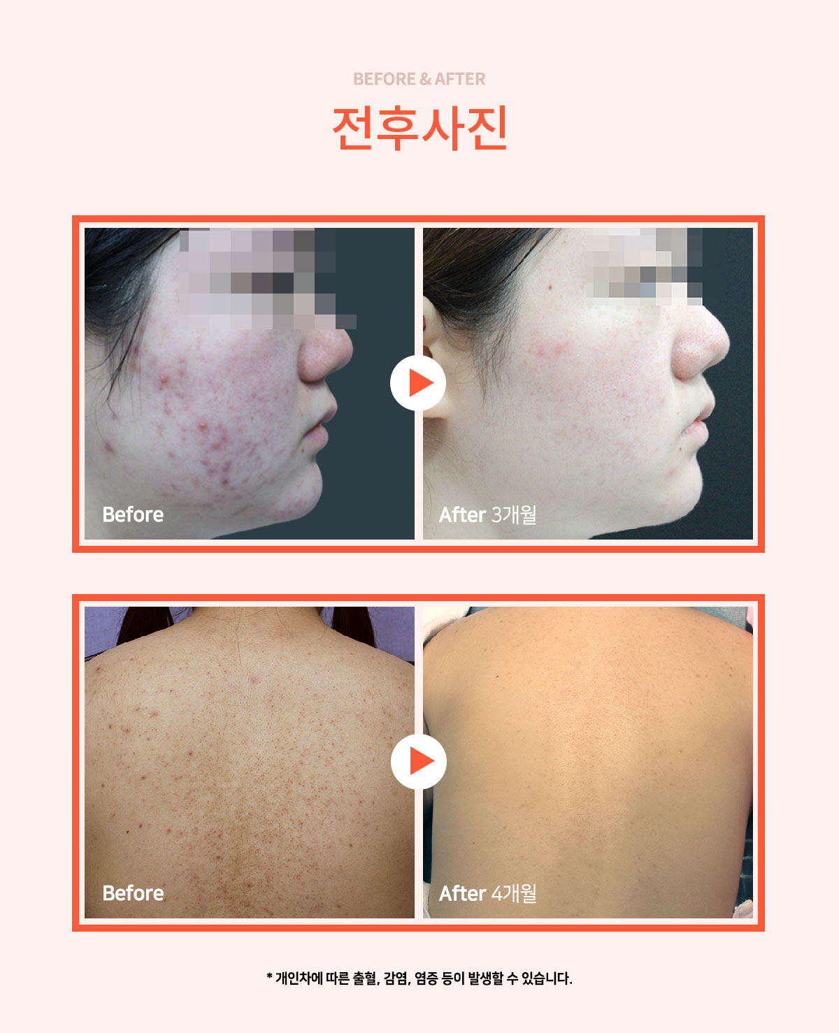 여드름치료 전후사진